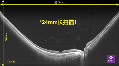 图湃医疗在2021年中国眼底病论坛惊艳亮相 新研发的24mm血流成像技术